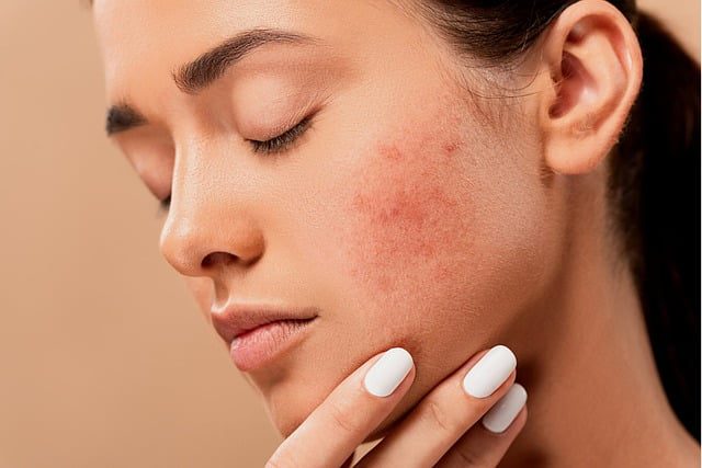 acne scars best remedies.jpg