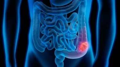 Prevention of colorectal cancer